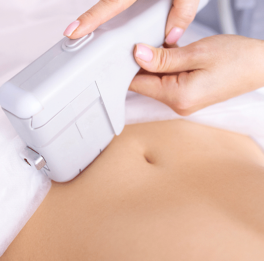 hifu body before and after 02