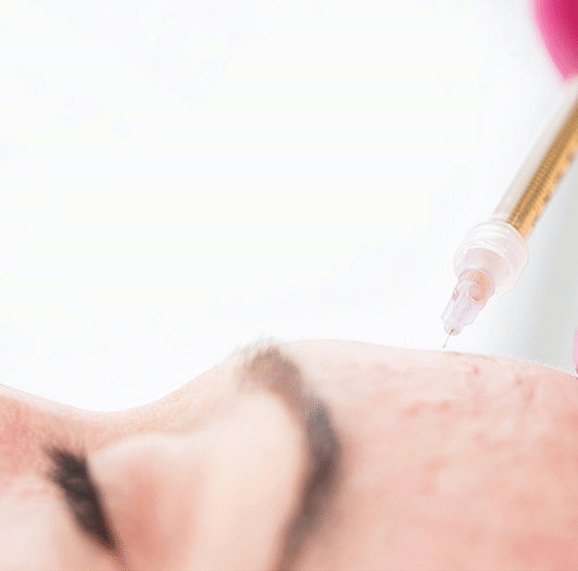 mesotherapy before and after 01