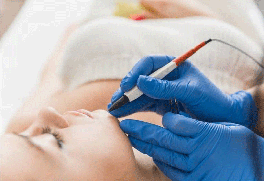 electrolysis post image