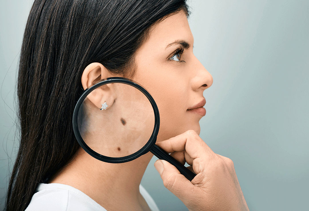 mole and leison assessment post image